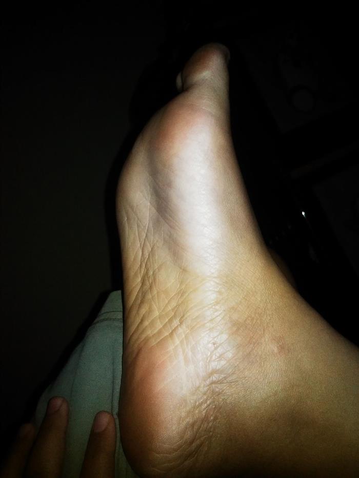 Terapi Sparsa untuk Telapak Kaki Flat